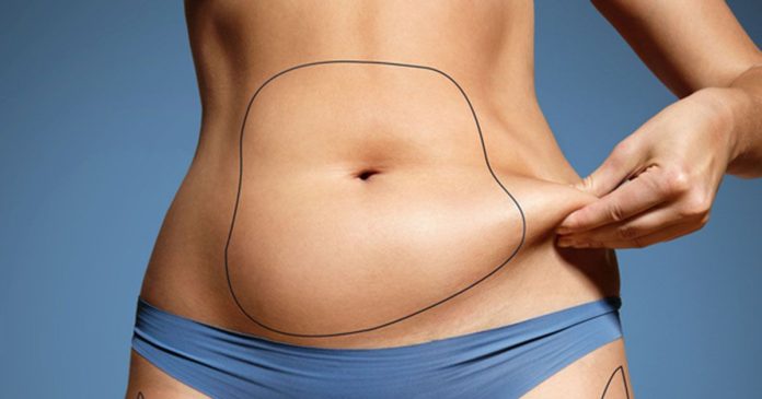 Coolsculpting tummy