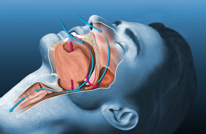 sleep apnea dentist