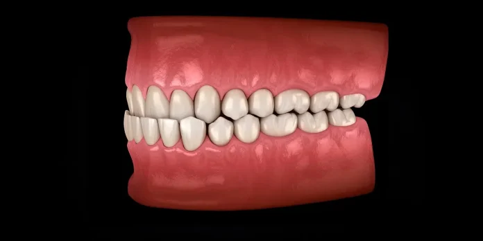 teeth underbite